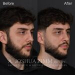 1 Month Post OSR R3.4V 1
