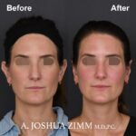 1 Otoplasty Before And After