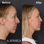 1 Chin Implant Before And After 1
