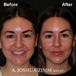 1 Chin Implant Before And After