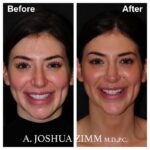 1 Chin Implant Before And After 2
