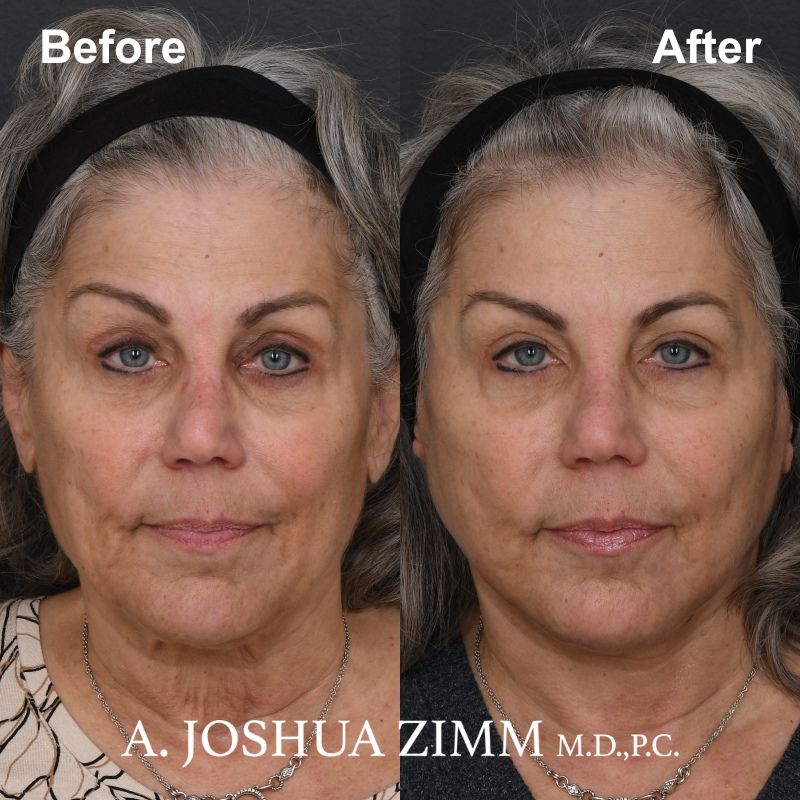 1 Facelift Before And After 1 1