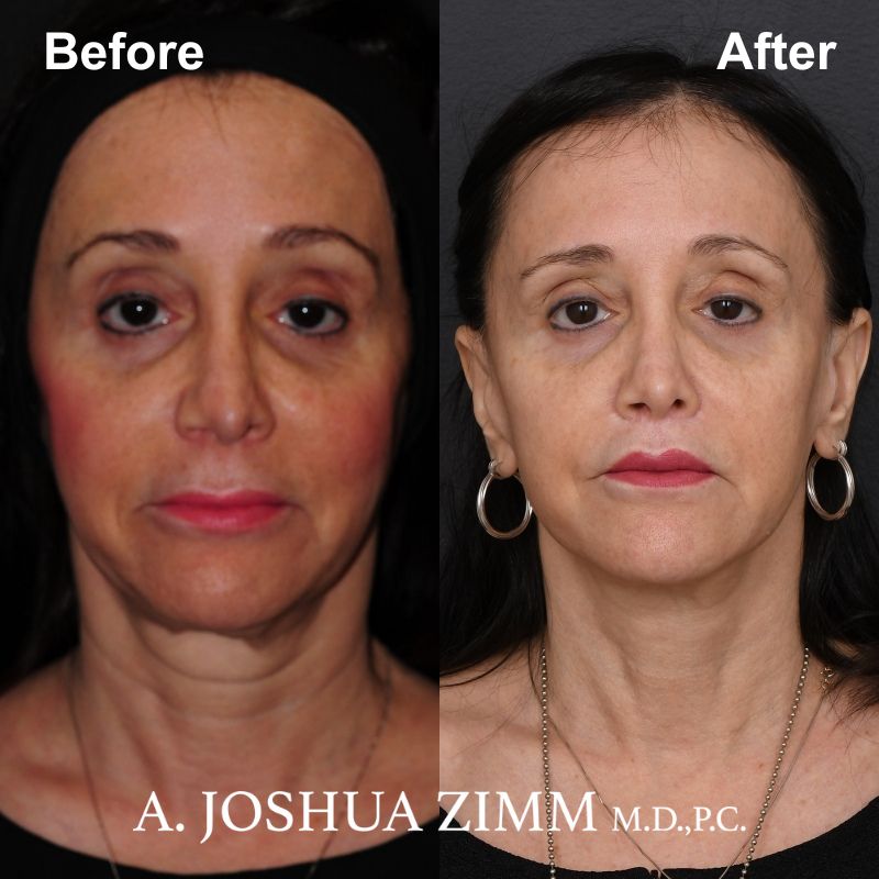 1 Facelift Before And After 1