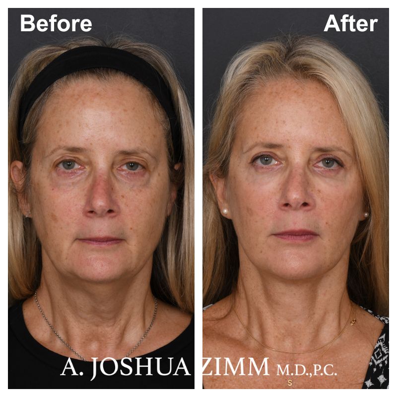 1 Facelift Before And After 3