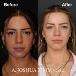 1 Revision Rhinoplasty 1
