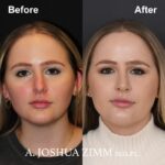 1 Revision Rhinoplasty
