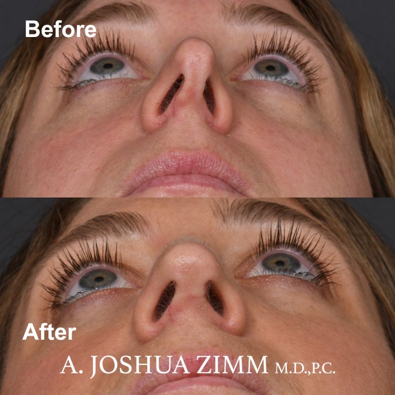 1 Revision Rhinoplasty 2