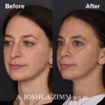 1 Revision Rhinoplasty 3