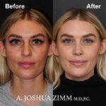 1 Rhinoplasty Before And After 1