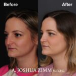 1 Rhinoplasty Before And After 10