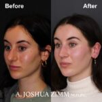 1 Rhinoplasty Before And After 15