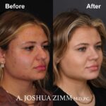 1 Rhinoplasty Before And After