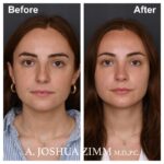 1 Rhinoplasty Before And After 16