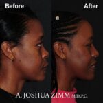 1 Rhinoplasty Before And After 17