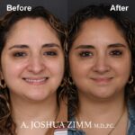1 Rhinoplasty Before And After 18