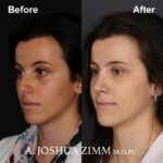 1 Rhinoplasty Before And After 21