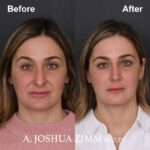 1 Rhinoplasty Before And After 22