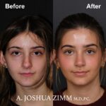 1 Rhinoplasty Before And After 25