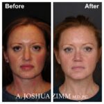 1 Rhinoplasty Before And After 27