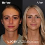 1 Rhinoplasty Before And After 28