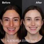 1 Rhinoplasty Before And After 29