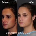 1 Rhinoplasty Before And After 3