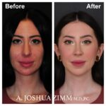 1 Rhinoplasty Before And After 30