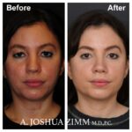 1 Rhinoplasty Before And After 33