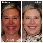 1 Rhinoplasty Before And After 35