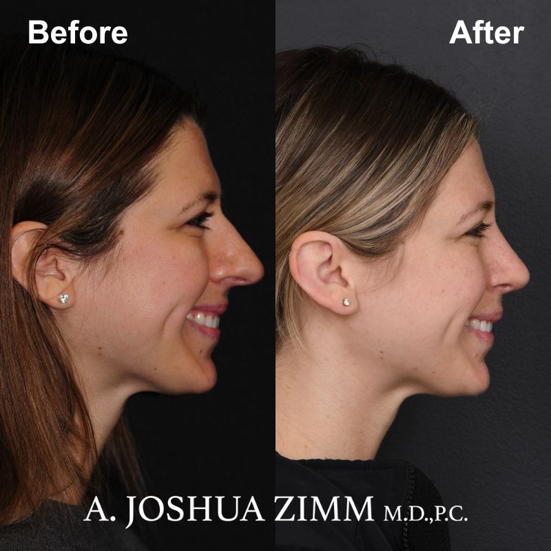 1 Rhinoplasty Before And After 36