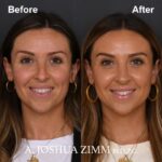 1 Rhinoplasty Before And After 38