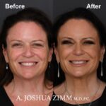 1 Rhinoplasty Before And After 4
