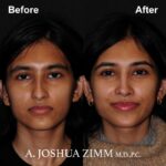 1 Rhinoplasty Before And After 40