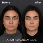 1 Rhinoplasty Before And After 43
