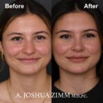 1 Rhinoplasty Before And After 44