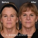 1 Rhinoplasty Before And After 48