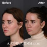 1 Rhinoplasty Before And After 49