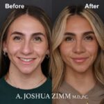 1 Rhinoplasty Before And After 5