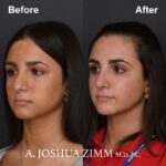 1 Rhinoplasty Before And After 51