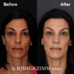 1 Rhinoplasty Before And After 52