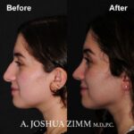 1 Rhinoplasty Before And After 54