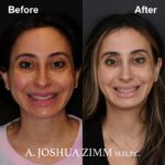 1 Rhinoplasty Before And After 56