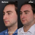 1 Rhinoplasty Before And After 57