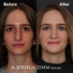1 Rhinoplasty Before And After 58