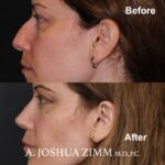 1 Rhinoplasty Before And After 59