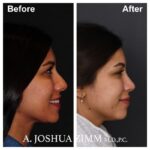 1 Rhinoplasty Before And After 62