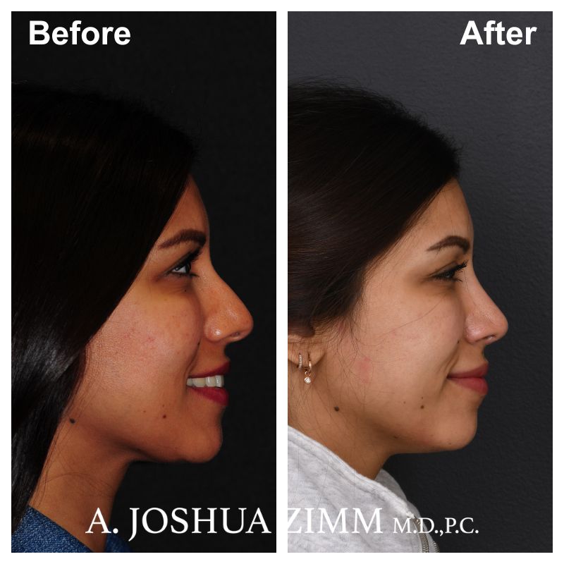 1 Rhinoplasty Before And After 62
