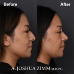 1 Rhinoplasty Before And After 7