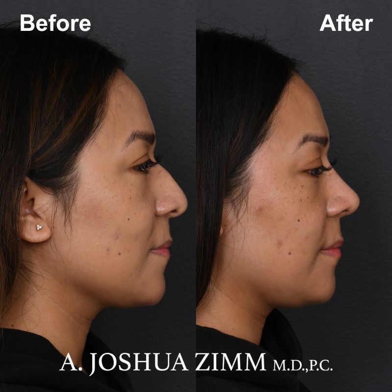 1 Rhinoplasty Before And After 7