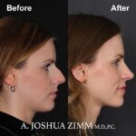 1 Rhinoplasty Before And After 8